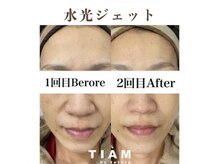 ティアム バイ テトテ 神戸三宮(TIAM by tetote)/水光ジェット