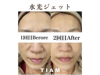 ティアム バイ テトテ 神戸三宮(TIAM by tetote)/水光ジェット