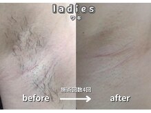 キュー(cue)/【レディース】「ワキ脱毛」