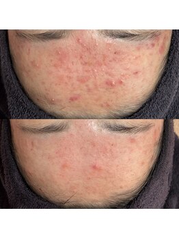 スピカ(Spica)/ニキビケア中~経過報告~