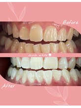 エクシアホワイトニング 札幌中島公園店/ホワイトニングビフォーアフター