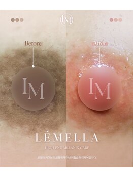 カルミア(kalmia)/メラニンケアルメラ