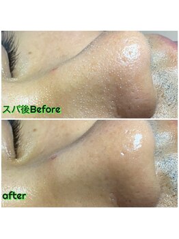 ビービー(BB)/#毛穴洗浄