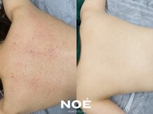ノエ 新宿(NOE)の雰囲気（ハーブピーリングは背中や二の腕、全身に施術可能です。）