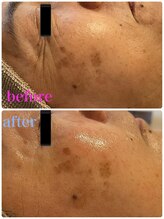 リヤン(Lien)/目尻の小ジワ改善に！