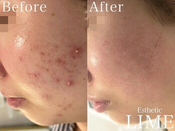 ライム 中野(LIME)/ハーブピーリング｜ニキビケア