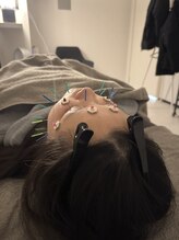 ラフテル鍼灸整骨院/自律神経の乱れに美容鍼♪