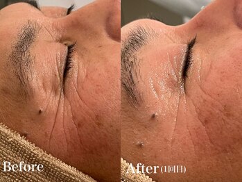 シャルム(Charme)/メンズフェイシャル♪シワケア