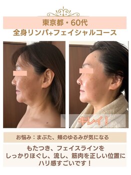 ルルドフォンテ(rurudo fonte.)/リフトアップすごい!