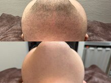 ボス 大曽根店(BOSS)/たった10回でこの変化＃ヒゲ脱毛