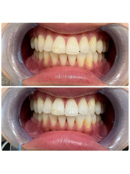 コナホワイトニング 神保町/セルフホワイトニング神保町