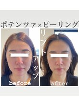 リノ ショウナン(LINO SHONAN)/ポテンツァ×ハーブピーリング