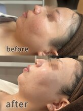 エスデザイン(es design)/美白/ニキビ/毛穴/復元パック