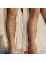 ファビー(Fabby)/メンズ脱毛★足のビフォアフ