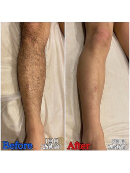 ファビー(Fabby)/メンズ脱毛★足のビフォアフ