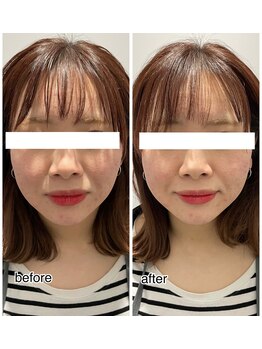 エンチャント(ENCHANT)/小顔造形