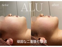 アルフォービューティー 恵比寿店(ALU for beauty)/HIRF LIFT症例