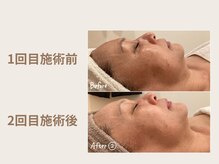 オムリス鍼灸接骨院/before after/ハーブピーリング