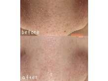 洗顔サロン 池袋(SENGAN)/つるんと透明感のある肌へ