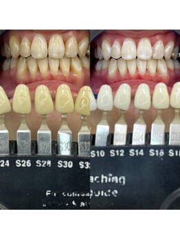 トウキョウスワーズ 池袋店(TOKYO SWRS)/#ホワイトニング #池袋 #渋谷