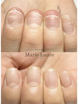マリーロール 天王寺店(Marie Laure)/自爪育成/深爪矯正/ネイルケア