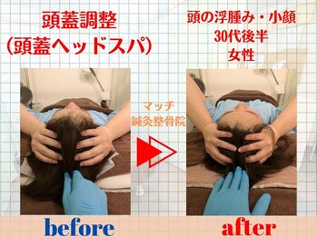 マッチ鍼灸整骨院/頭の浮腫み・小顔は頭から