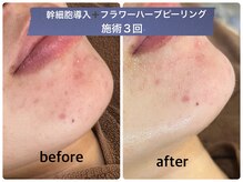 デューン 蕨店(Dune)/幹細胞/ハーブピーリング