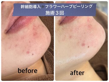 デューン 蕨店(Dune)/幹細胞/ハーブピーリング