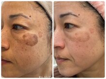 大きなシミを毎日隠すメイクから解放！肌改善ケア◎