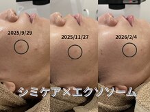 テセラ(Tethere)の雰囲気（ピンポイントでシミにアプローチ！目の周り濃いシミ、薄いシミ◎）