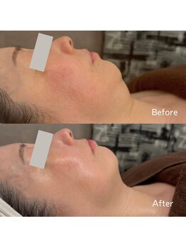 エルベ(ellbe)/小顔筋膜フェイシャル