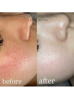 イデアル(Ideal)/【肌質改善】乳酸菌ピーリング