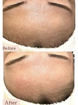 プアマヌ(PUA MANU)/ワックス光脱毛の効果