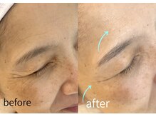 ルーム701(room701)の雰囲気（小顔/リフトアップ/たるみ改善/シワ改善/たるみ毛穴/）