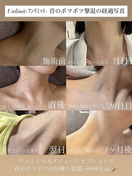 アンリミット(Unlimit)/首のポツポツ取り経過を大公開！