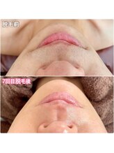 クラルス(clarus)/光フェイシャルで毛も可能