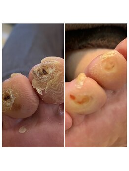 ニコ(niko)/指先の痛いタコのケア