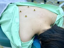 北戸田駅前鍼灸接骨院/お客様に合わせた鍼灸施術