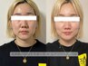 【 エイジングケアの決定版 】 美顔筋SOSEIテラボーラ × 高品質エクソソーム