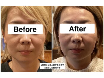 グリーン鍼灸整体院(green鍼灸整体院)/美容鍼