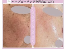 ストーリー 岐阜店(STORY)/ハーブピーリング専門店STORY