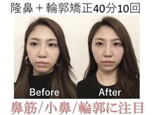 ラプリ 梅田店(Raplit)/隆鼻＋輪郭矯正40分10回