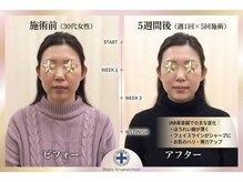 井原鍼灸整骨院/IAB美容鍼
