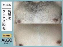アルゴ 柳川店(ALGO)/胸WAX脱毛