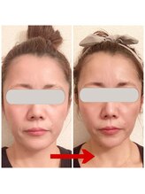 グロッシー(glossy)/小顔矯正