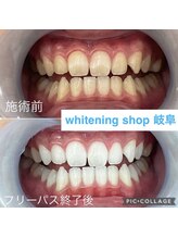 ホワイトニングショップ 岐阜駅前/#岐阜ホワイトニング#岐阜エステ