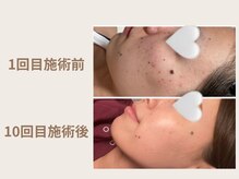 オムリス鍼灸接骨院/before after/ハーブピーリング