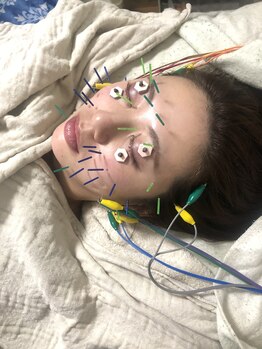 インフィニティ 名古屋金山(INFINITY)/美容鍼は化粧したまま施術◎