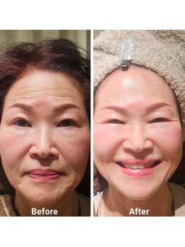 アン 銀座(ann)/エクソソーム1回目