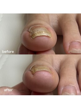 巻き爪矯正3回目（左親指）